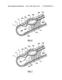 Balloon Catheter Systems and Methods for Bypassing an Occlusion in a Blood     Vessel diagram and image