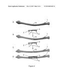 ORTHOPEDIC BONE FIXATION SYSTEMS AND METHODS diagram and image