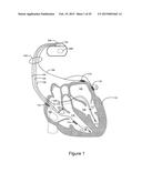 CARDIAC RESPONSE CLASSIFICATION USING MULTISITE SENSING AND PACING diagram and image