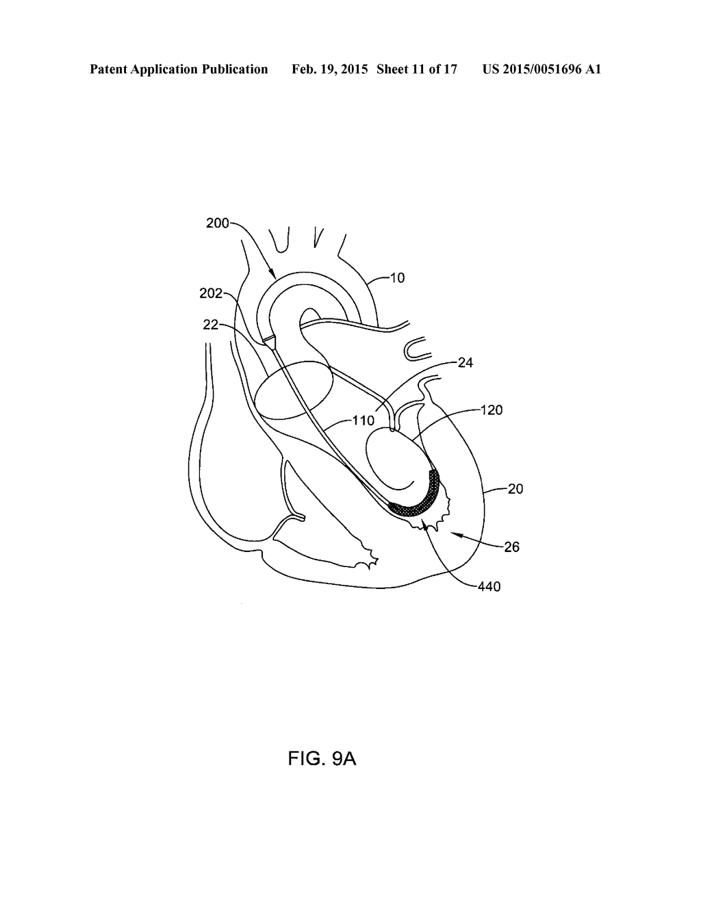 MEDICAL GUIDEWIRE - diagram, schematic, and image 12