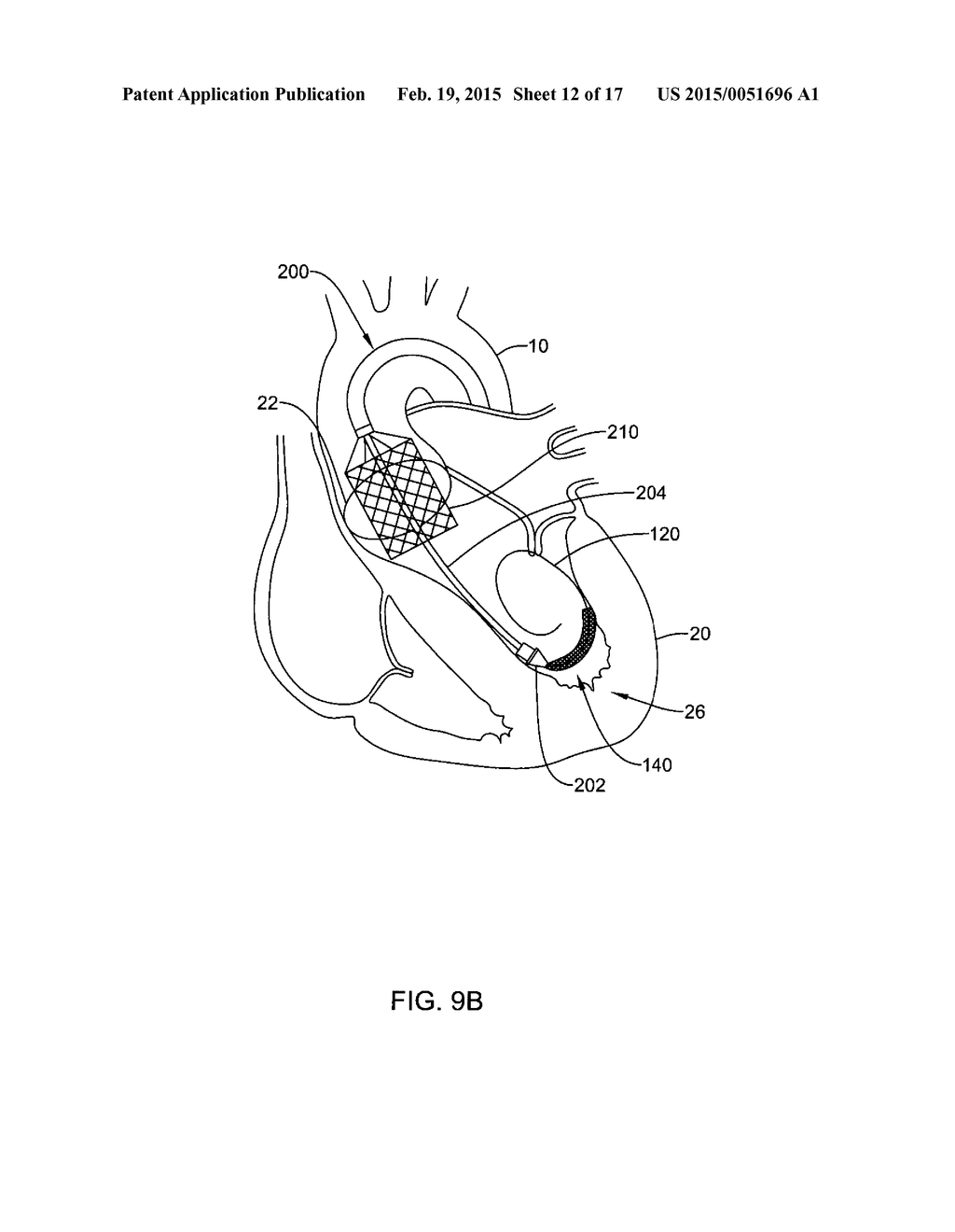 MEDICAL GUIDEWIRE - diagram, schematic, and image 13