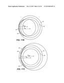 INTRAOCULAR IMPLANTS AND RELATED KITS AND METHODS diagram and image