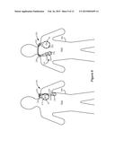 Self-Affixing External Charging System for an Implantable Medical Device diagram and image