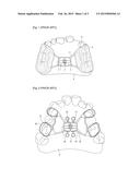 Maxillary Skeletal Expander Using Mini-Screw diagram and image