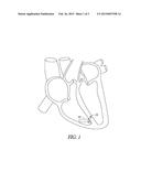 LEADLESS PACEMAKER WITH TRIPOLAR ELECTRODE diagram and image