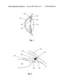 TRABECULAR MESHWORK STIMULATION DEVICE diagram and image