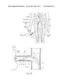 Catheter Apparatuses, Systems, and Methods for Renal Neuromodulation diagram and image