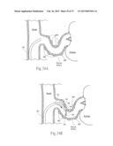 Catheter Apparatuses, Systems, and Methods for Renal Neuromodulation diagram and image