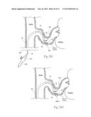 Catheter Apparatuses, Systems, and Methods for Renal Neuromodulation diagram and image