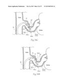 Catheter Apparatuses, Systems, and Methods for Renal Neuromodulation diagram and image