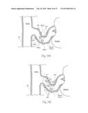 Catheter Apparatuses, Systems, and Methods for Renal Neuromodulation diagram and image