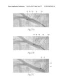 Catheter Apparatuses, Systems, and Methods for Renal Neuromodulation diagram and image