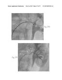 Catheter Apparatuses, Systems, and Methods for Renal Neuromodulation diagram and image