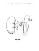 STEERABLE ABLATION CATHETER FOR RENAL DENERVATION diagram and image