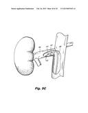 STEERABLE ABLATION CATHETER FOR RENAL DENERVATION diagram and image