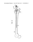 FLEXIBLE INTRAMEDULLARY ROD diagram and image