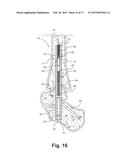 Intramedullary Nail, System, and Method With Dynamic Compression diagram and image