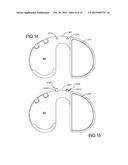 Knee Prosthesis Assembly With Ligament Link diagram and image