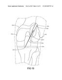 Knee Prosthesis Assembly With Ligament Link diagram and image