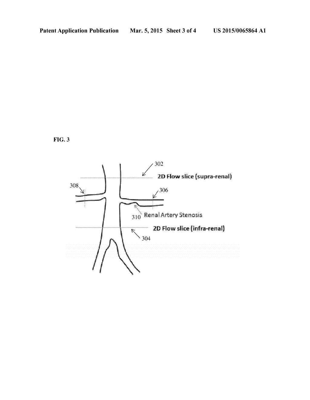 Method and System for Functional Assessment of Renal Artery Stenosis from     Medical Images - diagram, schematic, and image 04