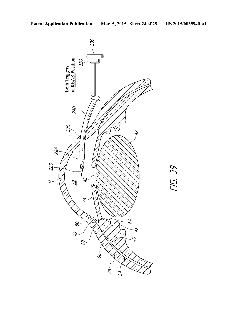 SYSTEMS AND METHODS FOR DELIVERING AN OCULAR IMPLANT TO THE SUPRACHOROIDAL     SPACE WITHIN AN EYE - diagram, schematic, and image 25