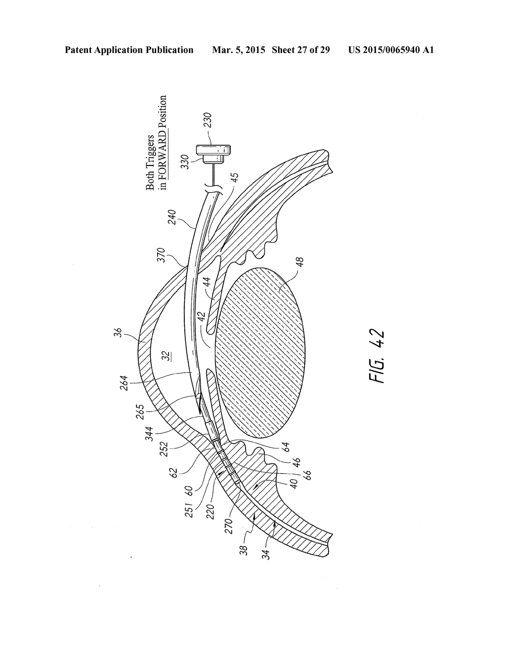 SYSTEMS AND METHODS FOR DELIVERING AN OCULAR IMPLANT TO THE SUPRACHOROIDAL     SPACE WITHIN AN EYE - diagram, schematic, and image 28
