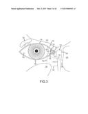 IMPLANTATION TOOLS, TOOL ASSEMBLIES, KITS AND METHODS diagram and image