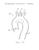 INTRODUCER SHEATH WITH EMBOLIC PROTECTION diagram and image