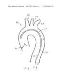 INTRODUCER SHEATH WITH EMBOLIC PROTECTION diagram and image