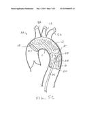 INTRODUCER SHEATH WITH EMBOLIC PROTECTION diagram and image