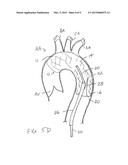 INTRODUCER SHEATH WITH EMBOLIC PROTECTION diagram and image