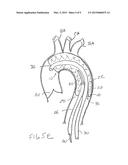 INTRODUCER SHEATH WITH EMBOLIC PROTECTION diagram and image