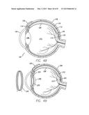 Flexible Circuit Electrode Array Embedded in a Cured Body diagram and image