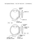 Flexible Circuit Electrode Array Embedded in a Cured Body diagram and image