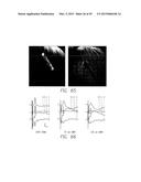 Flexible Circuit Electrode Array Embedded in a Cured Body diagram and image