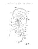 DELIVERY OF MEDICAL DEVICES diagram and image