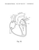 Devices and Methods for Locating and Implanting Tissue Anchors at Mitral     Valve Commissure diagram and image