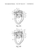 Devices and Methods for Locating and Implanting Tissue Anchors at Mitral     Valve Commissure diagram and image