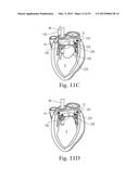 Devices and Methods for Locating and Implanting Tissue Anchors at Mitral     Valve Commissure diagram and image