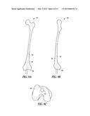 METHOD FOR OPTIMIZING IMPLANT DESIGNS diagram and image