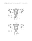 INTRAUTERINE DEVICE diagram and image