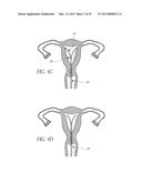 INTRAUTERINE DEVICE diagram and image