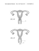 INTRAUTERINE DEVICE diagram and image