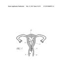 INTRAUTERINE DEVICE diagram and image