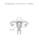 INTRAUTERINE DEVICE diagram and image