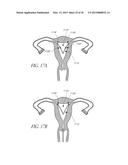 INTRAUTERINE DEVICE diagram and image