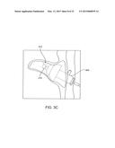 SYSTEMS AND METHODS FOR ANESTHETIZING EAR TISSUE diagram and image