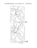 SYSTEM FOR MYOMECTOMY AND MORCELLATION diagram and image