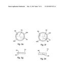 FLEXIBLE STRETCHABLE TROCAR TO FACILITATE SINGLE INCISION LAPAROSCOPIC     SURGERY diagram and image