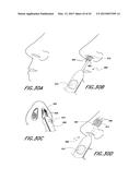 METHODS AND DEVICES TO TREAT NASAL AIRWAYS diagram and image